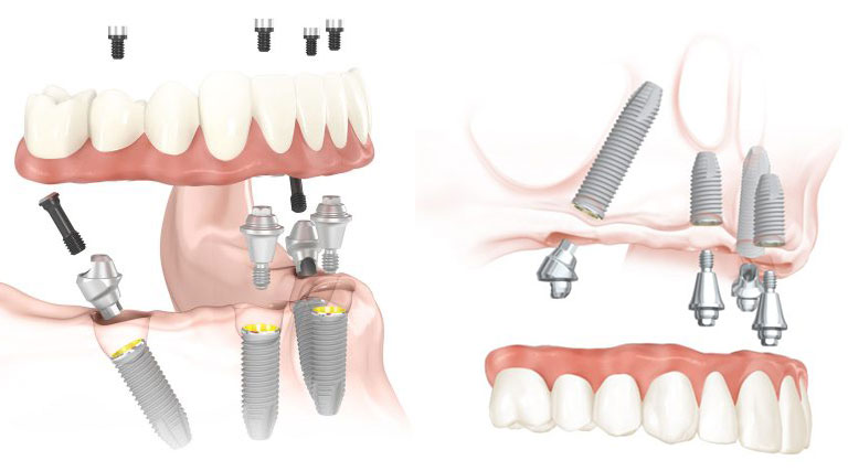 Low Cost All On 4 Dental Implants Toronto Canada Axis Dental